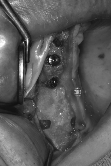 만성치주염으로 인해 아주 좁아진 잇몸뼈에 광범위한 뼈이식 + 전체임플란트. 신사 레브치과. 관련 이미지 24