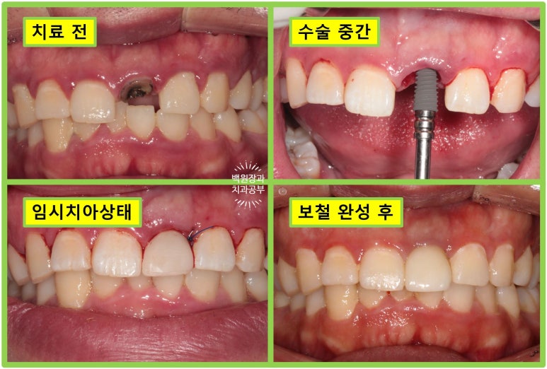 앞니 머리가 기둥째 부러졌어요. 발치 동시 뼈이식 오스템 BA 임플란트. 치료과정/치료기간/비용/후기. 압구정 치과. 관련 이미지 26