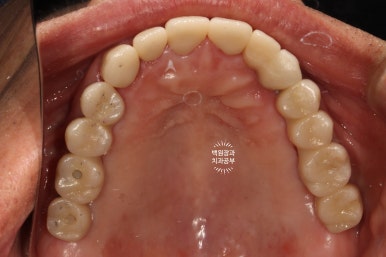 임플란트장인의 마음으로 8개월간 전체임플란트 완성. 치주과 전문의. 관련 이미지 31