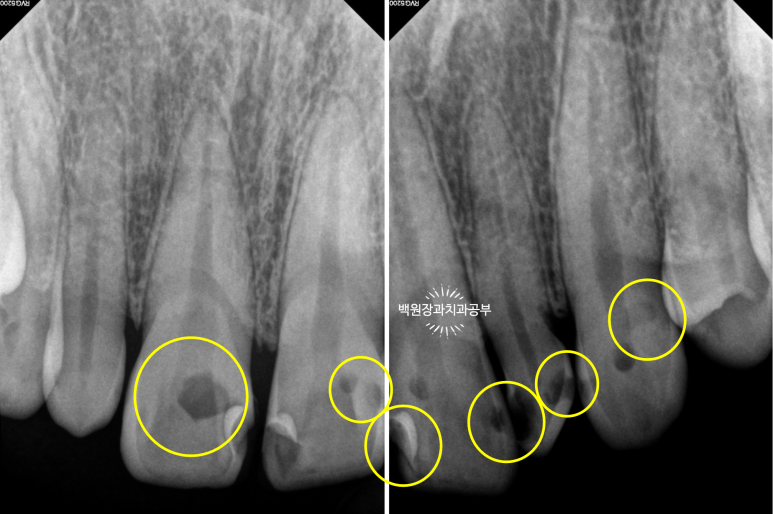 앞니에 잇몸염증과 충치가 심해요. 앞니 지르코니아 크라운 성공 후기. 치료과정/치료기간/비용/전후비교. 관련 이미지 8