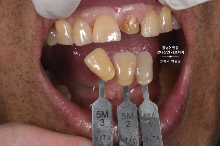 강남논현동치과 60대 치아부러짐 - 신경치료하고 기둥심고 앞니 크라운 잘하는곳! 가격/과정/후기/부작용. 관련 이미지 9