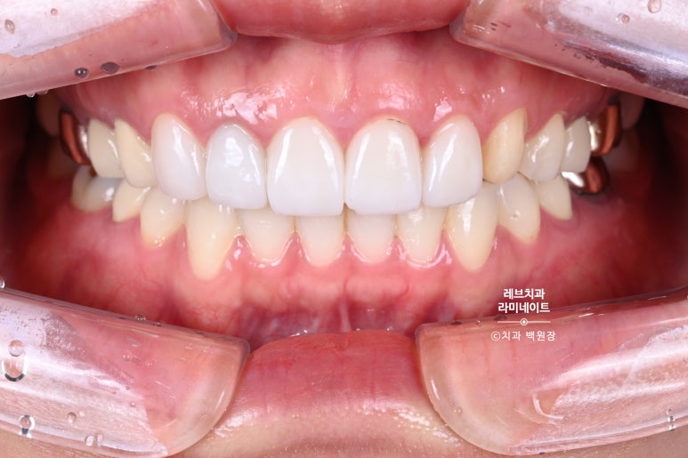 신사역 퍼스널컬러 맞춤 치과. 전담 세라미스트가 앞니 크라운과 라미네이트를 만들어 드립니다. 관련 이미지 2