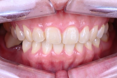 신사역 라미네이트. 결혼식 전 앞니 고민, 얇은 세라믹 레브네이트로 해결! 관련 이미지 26