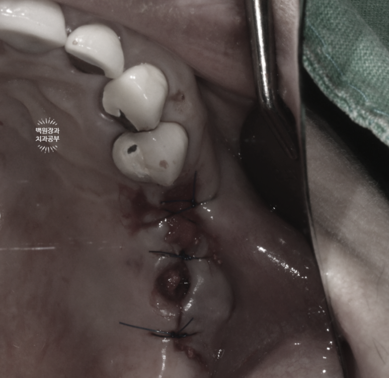 임플란트에서 고름이 나와요. 임플란트 주위염 그리고 재수술을 위한 준비. 치료과정/치료기간/비용/후기. 관련 이미지 19