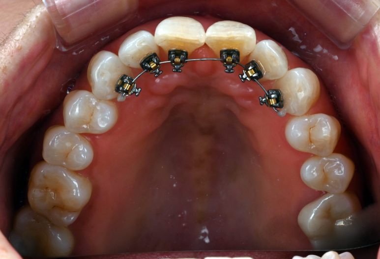 일요일치과 압구정 강남교정치과. 치아교정 라인업; 인비절라인, 클리피씨, 클라리티 울트라. 장점/단점/비용/후기. 관련 이미지 10