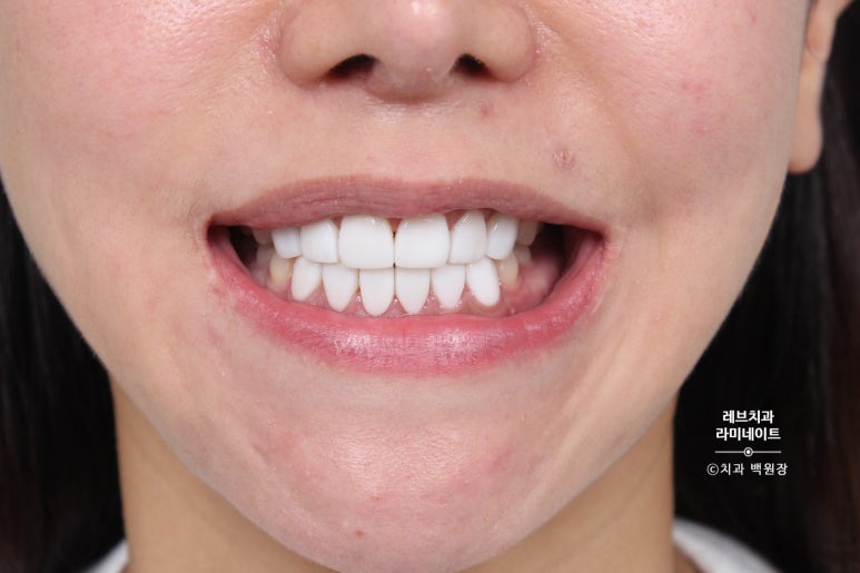 레브네이트 베이직. 치아미백과 치아교정을 한번에! 치아삭제 사진 있음. 신사역 치과 앞니라미네이트 모델/비용/후기. 관련 이미지 19