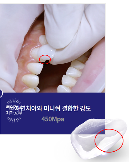 서울 신사역 [레브치과] 아래 앞니 치아 사이 틈 (블랙 트라이앵글) -  바이오클리어 치과에서 깔끔하게 해결. 관련 이미지 3