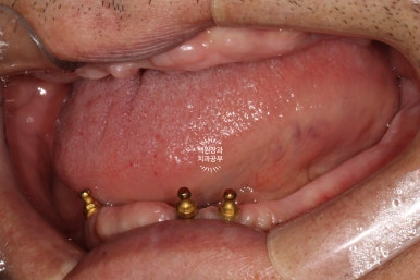 불편한 틀니를 아직도 쓰시나요? 전체 임플란트 치료비용/치료기간/치료과정. 관련 이미지 7