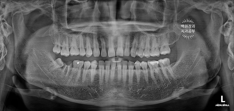 아래 어금니가 없어 위 어금니가 내려왔어요. 부분 교정을 곁들인 스트라우만 임플란트 수술. 억울한 신경치료를 피해보자. 치료과정/치료기간/비용/후기. 관련 이미지 2