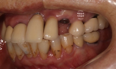 스트라우만 임플란트로 이뽑고 바로심는치과 - 믿고 사용하는 세계 1위 스위스 임플란트 회사. 관련 이미지 13