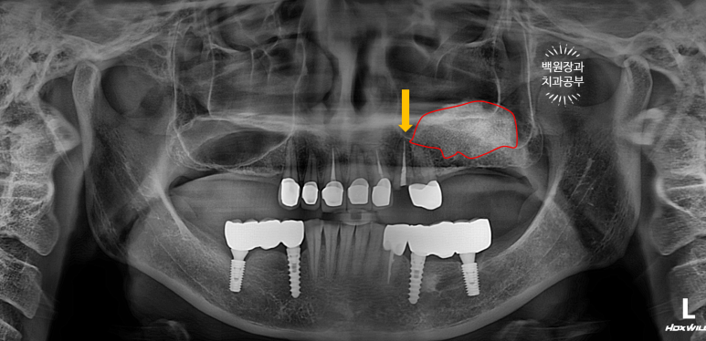 부분틀니 대신 어금니 임플란트를 만들어드립니다. 40대 어금니 상악동 뼈이식 임플란트. 치료기간/비용/과정. 관련 이미지 2