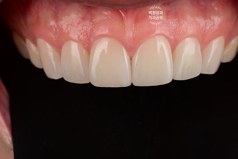 A European Patient at [Rev Dental Clinic] near Sinsa Station in Seoul Wanted Front Tooth Decay Treated with an EMAX All-Ceramic Crown. image 8