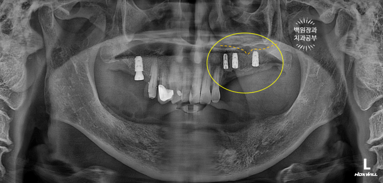 아래 어금니 임플란트 6개면 틀니를 안써도 됩니다.  치주염 전문 착한치과. 치료기간/임시치아과정/후기/비용. 관련 이미지 13