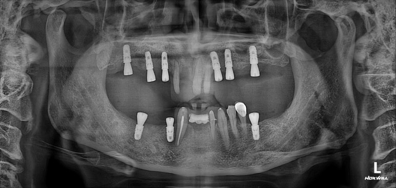 큰 어금니를 잃을 정도의 풍치를 앓으셨다면, 조속한 어금니 임플란트는 필수입니다. 관련 이미지 12