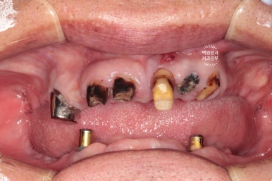 임플란트틀니 - 오버덴쳐. 오스템BA임플란트 이용한 최고의 가성비 치료. 치료과정/치료기간/비용/후기. 관련 이미지 21