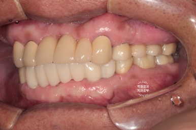 뿌리만 남은 앞니, 어금니가 없어 교합이 무너진 증례. 흡연자의 전체 오스템BA임플란트 재건증례. 치료과정/치료기간/비용/후기. 관련 이미지 22