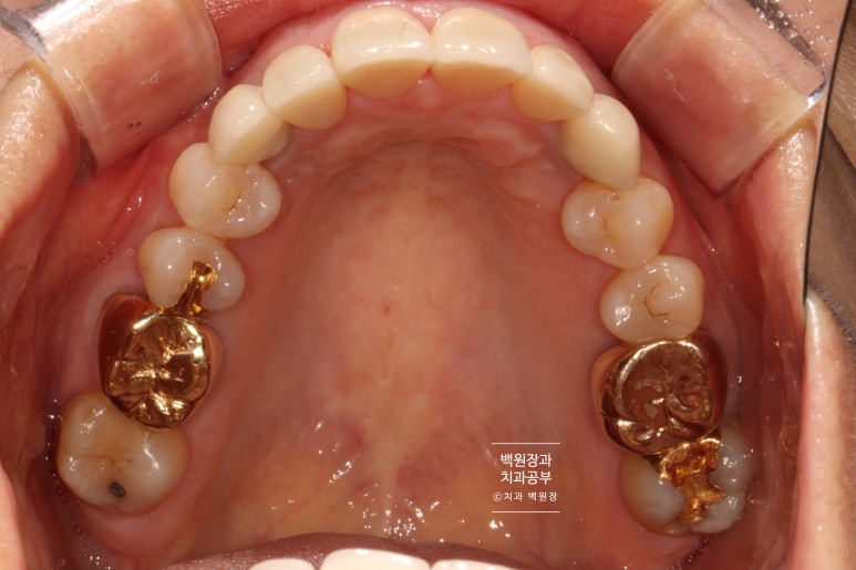 크라운 앞니 충치로 냄새가 나요 - 최소한의 임플란트와 씌우는 치료. 치료과정/기간/비용. 관련 이미지 16