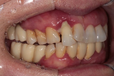 앞니가 풍치로 흔들거려요. 심한 치주염인데 임플란트 가능할까요? 치료과정/치료기간/비용/성공후기. 신금호역 치과 추천. 관련 이미지 3