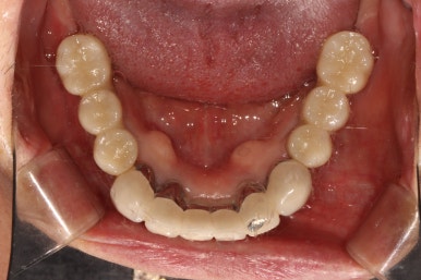 부분틀니를 오래써서 어금니가 아플 때, 아래턱 양쪽 어금니 임플란트 잘하는 강남임플란트치과 관련 이미지 26