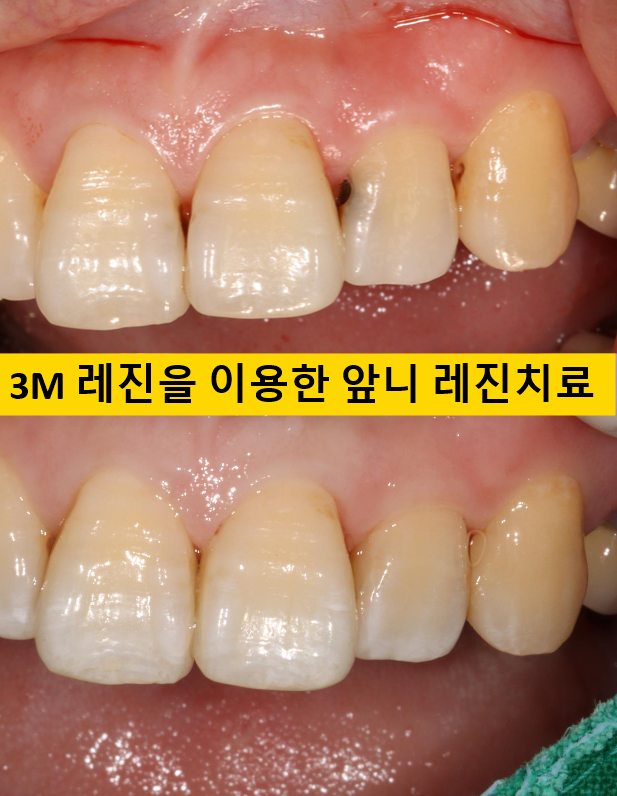 앞니레진치료 할 줄 모르는 치과의사는 없지만, 좋은 레진으로 치료하는 치과의사는 잘 없습니다. 관련 이미지 1