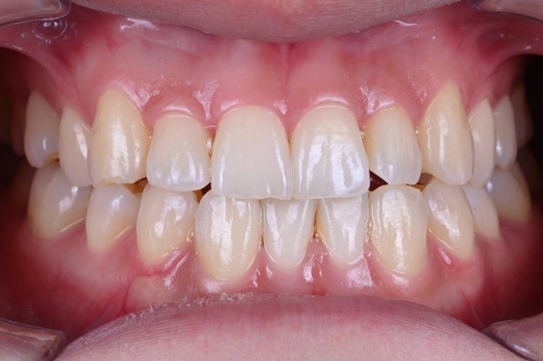 강남 치아미백 성지 레브치과. 가격/비용/부작용/전후사진. 관련 이미지 13