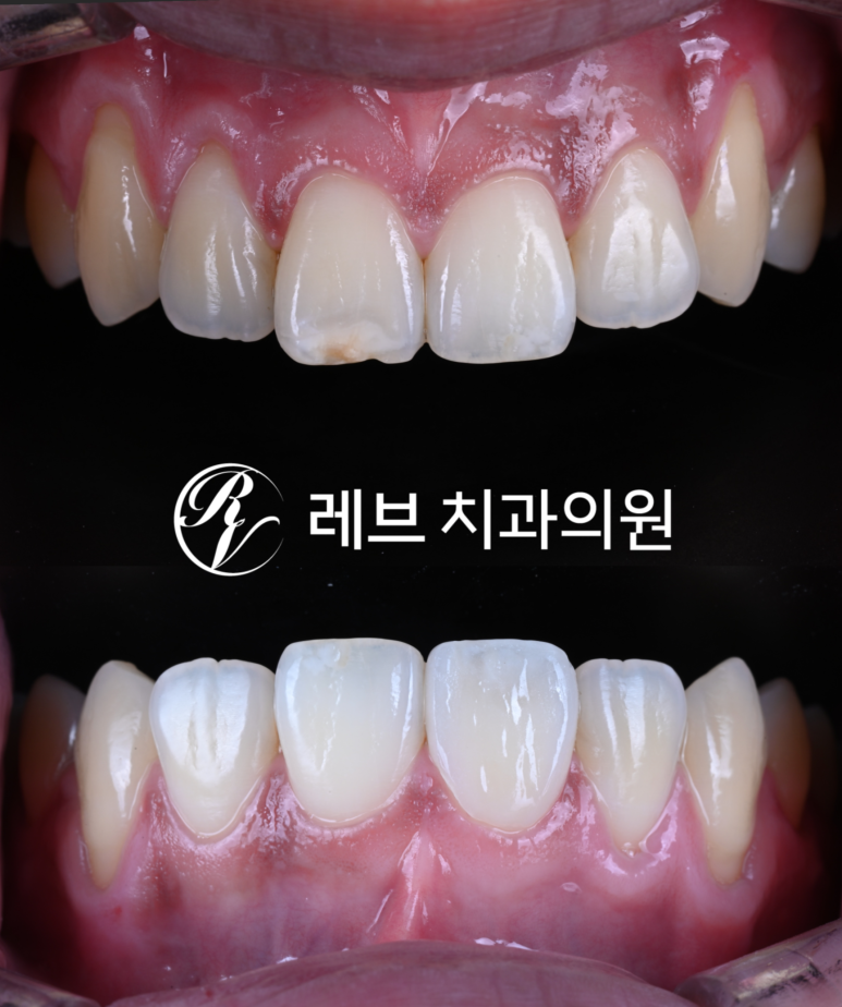 레브네이트 마스터 ; 예비신랑 앞니 무삭제라미네이트. 신사역 치과. 치료후기/비용/가격. 관련 이미지 1