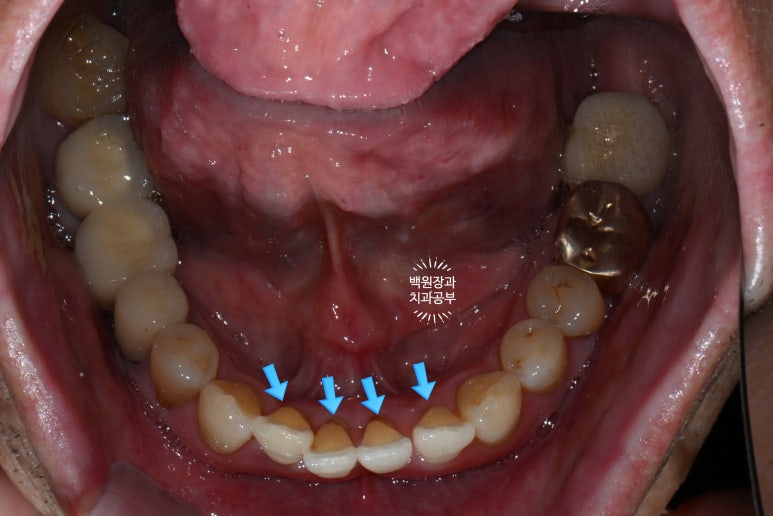 Seoul Sinsa Station [Lev Dental Clinic] For chronic periodontitis, extract the lower front teeth and make the crown look even more real than the real thing with an implant. image 3