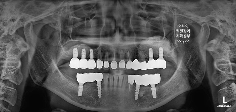 부분틀니 대신 어금니 임플란트를 만들어드립니다. 40대 어금니 상악동 뼈이식 임플란트. 치료기간/비용/과정. 관련 이미지 27