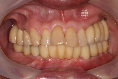 아래 어금니 임플란트 6개면 틀니를 안써도 됩니다.  치주염 전문 착한치과. 치료기간/임시치아과정/후기/비용. 관련 이미지 33