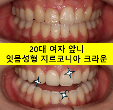 잇몸 성형과 치아미백 그리고 지르코니아 20대 앞니 크라운 치료. 치료과정/기간/비용. 관련 이미지 1