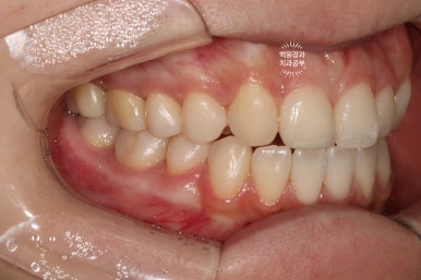 잇몸 성형과 치아미백 그리고 지르코니아 20대 앞니 크라운 치료. 치료과정/기간/비용. 관련 이미지 13