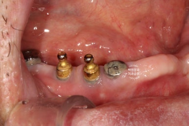 불편한 틀니를 아직도 쓰시나요? 전체 임플란트 치료비용/치료기간/치료과정. 관련 이미지 15