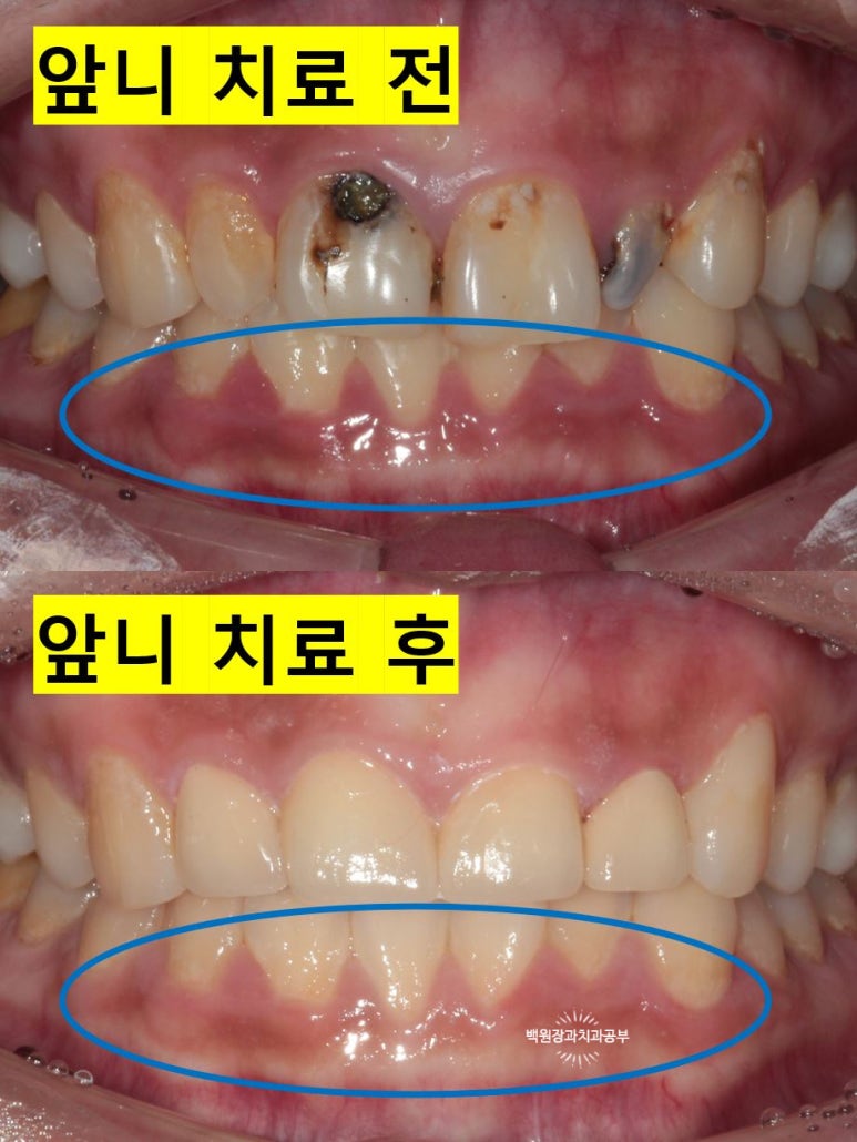 앞니에 잇몸염증과 충치가 심해요. 앞니 지르코니아 크라운 성공 후기. 치료과정/치료기간/비용/전후비교. 관련 이미지 22