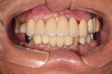 잇몸 염증 고름이 심했던 부위 - 만성치주염 진단하고 임플란트로 깔끔하게 치료! 신사역 치과 관련 이미지 26