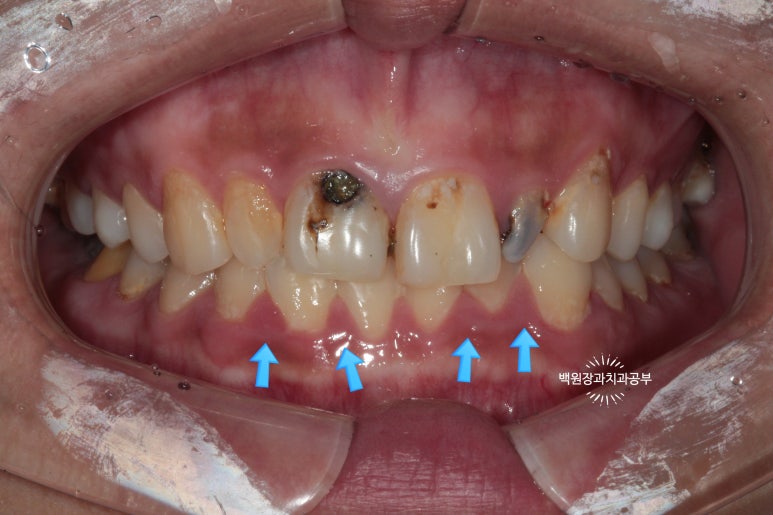 앞니에 잇몸염증과 충치가 심해요. 앞니 지르코니아 크라운 성공 후기. 치료과정/치료기간/비용/전후비교. 관련 이미지 5