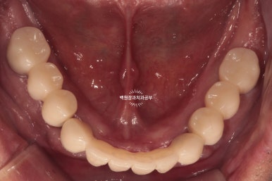 오스템임플란트 네비게이션 전체 임플란트 치료일기. 치료과정/치료기간/비용/솔직후기. 관련 이미지 33