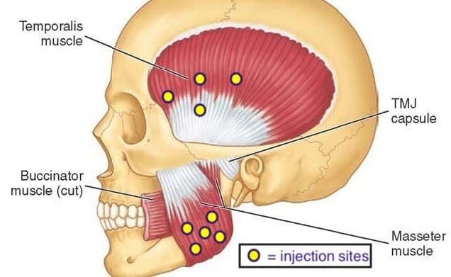 이갈이 마우스피스를 맞추기 전에, 저작근을 이해하고 측두근 보톡스를 맞아보세요! 관련 이미지 6