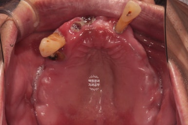 만성치주염으로 인해 아주 좁아진 잇몸뼈에 광범위한 뼈이식 + 전체임플란트. 신사 레브치과. 관련 이미지 7