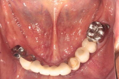 잇몸 염증 고름이 심했던 부위 - 만성치주염 진단하고 임플란트로 깔끔하게 치료! 신사역 치과 관련 이미지 8