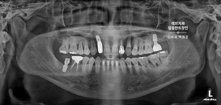 앞니 부러짐? 뽑고 바로 임플란트 + 뼈이식. 앞니 흔들림? 뽑고 1달 기다리고 임플란트 + 뼈이식. 신사역 치과 후기/비용/과정. 관련 이미지 13