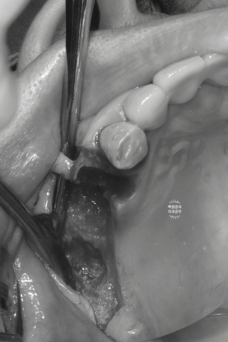 60대 임플란트 주변에서 고름이 나와요. 실패한 임플란트 제거 후 재수술. 덴티움 뼈이식재를 사용한 치조골 이식술. 관련 이미지 5