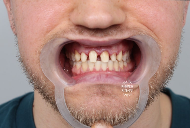 A European Patient at [Rev Dental Clinic] near Sinsa Station in Seoul Wanted Front Tooth Decay Treated with an EMAX All-Ceramic Crown. image 7