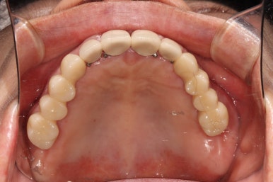 어금니 여러개가 없어요. 전체 임플란트와 앞니 크라운을 통한 완벽한 재건!! 치료과정/치료기간/비용/후기. 관련 이미지 25