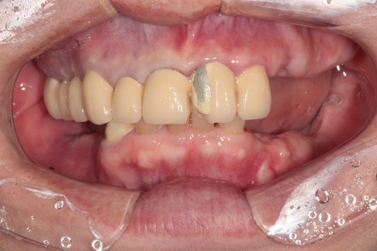 어금니 여러개가 없어요. 전체 임플란트와 앞니 크라운을 통한 완벽한 재건!! 치료과정/치료기간/비용/후기. 관련 이미지 2