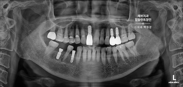 앞니 부러짐? 뽑고 바로 임플란트 + 뼈이식. 앞니 흔들림? 뽑고 1달 기다리고 임플란트 + 뼈이식. 신사역 치과 후기/비용/과정. 관련 이미지 11