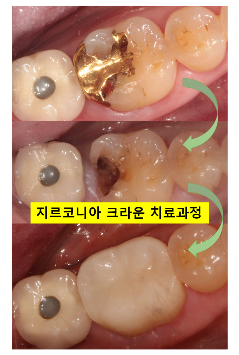 어금니 보철물이 떨어졌어요. 골드인레이 탈락 후 지르코니아 크라운으로 치료. 충치치료과정/치료기간/비용/후기. 관련 이미지 1