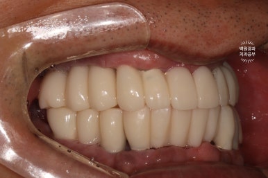 만성치주염으로 인해 아주 좁아진 잇몸뼈에 광범위한 뼈이식 + 전체임플란트. 신사 레브치과. 관련 이미지 52