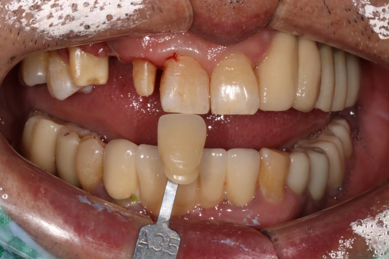 치주염 앞니 잇몸 염증으로 흔들릴 때 - 앞니 브릿지와 임플란트 장단점, 비용. 치료과정과 결과를 눈으로 보여주는 치과. 관련 이미지 12