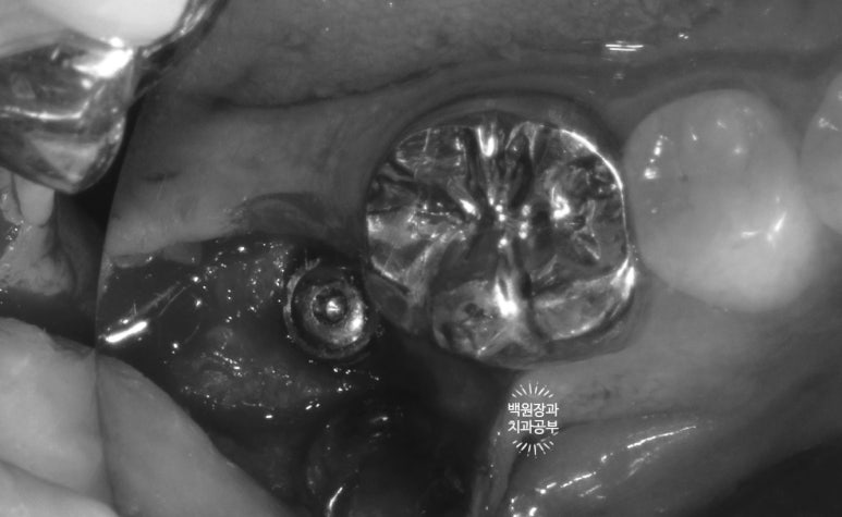 신경치료한 치아 부러짐! 뼈이식 하면서 임플란트 수술하는 과정/기간/비용. 관련 이미지 6