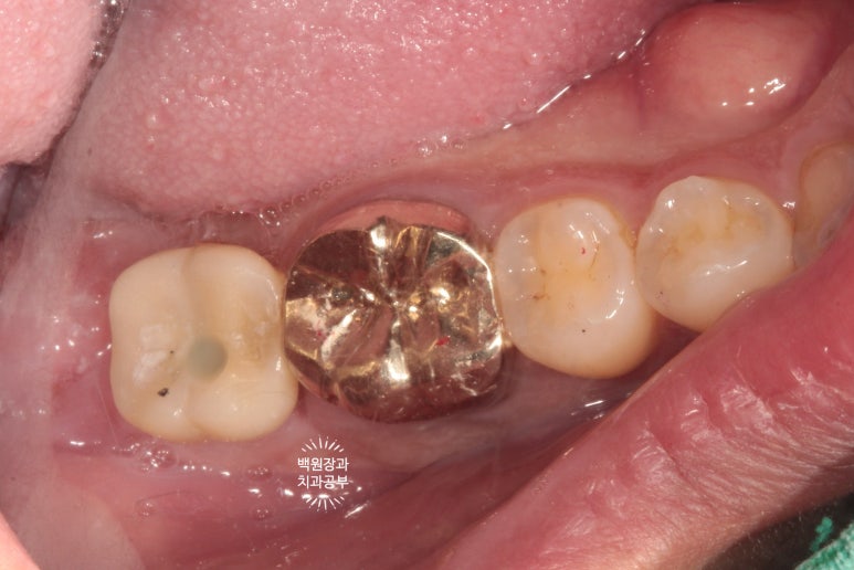 신경치료한 치아 부러짐! 뼈이식 하면서 임플란트 수술하는 과정/기간/비용. 관련 이미지 16